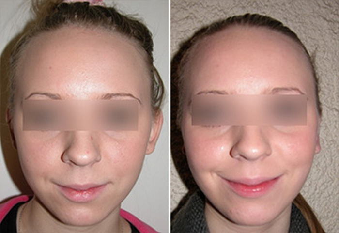 Фото до и после Отопластика СПб | клиника "АндроМеда"